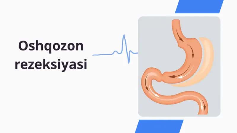 Oshqozon rezeksiyasi 1
