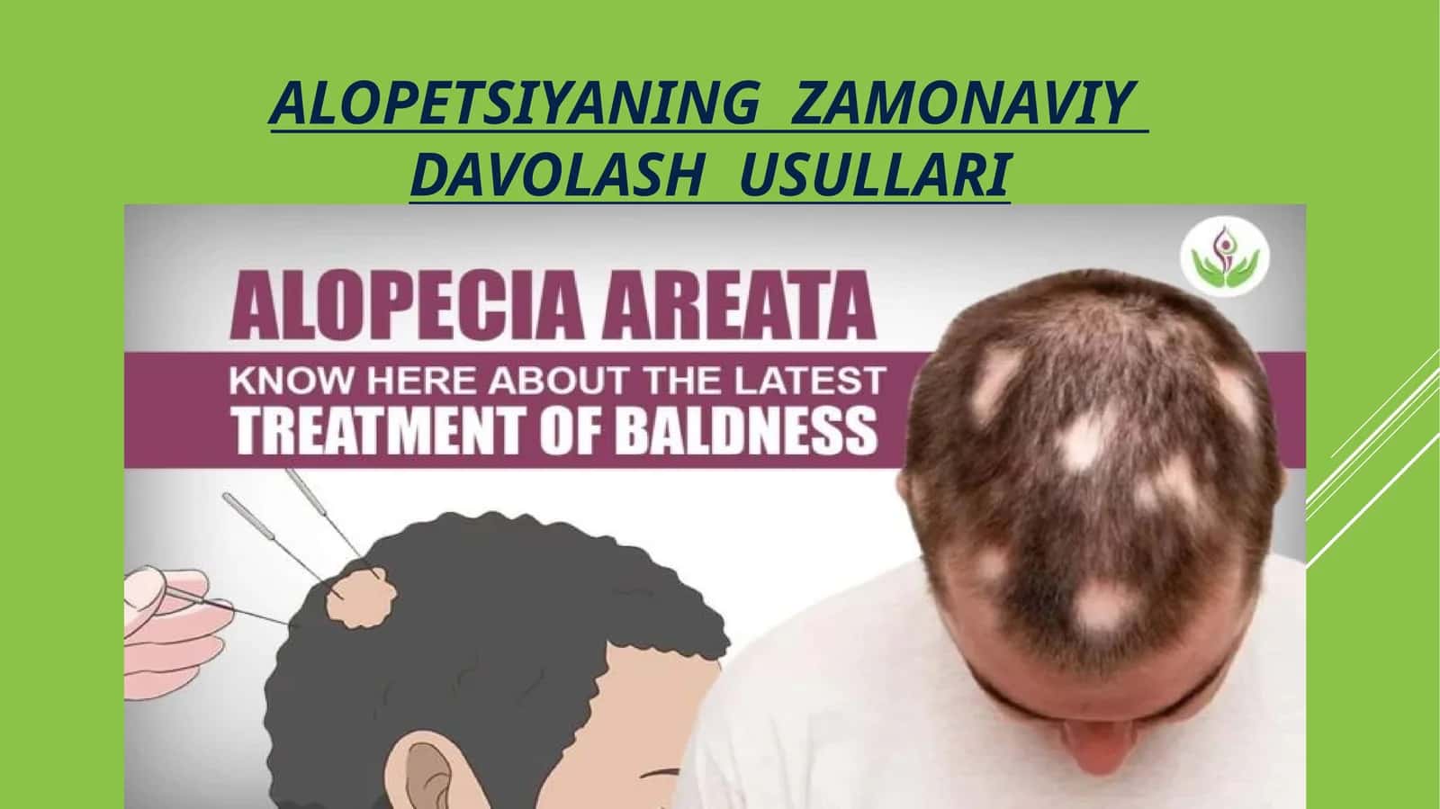 ALOPETSIYANING ZAMONAVIY DAVOLASH USULLARI 1