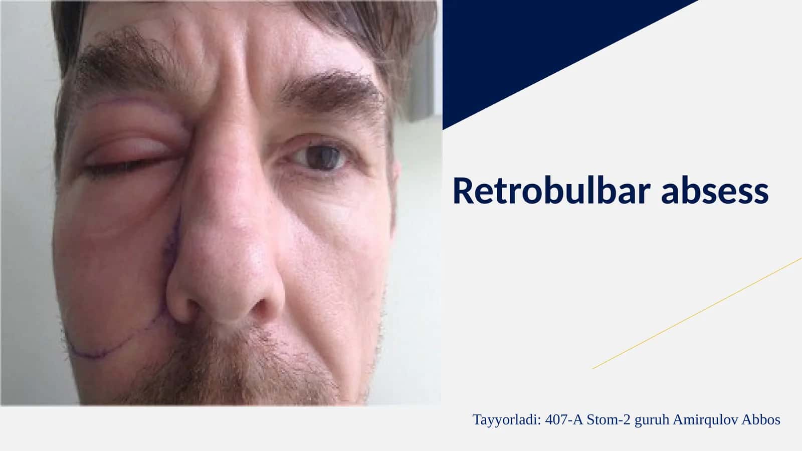 Retrobulbarabsess 1