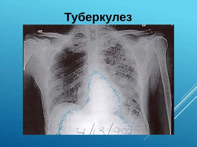 Туберкулез 1