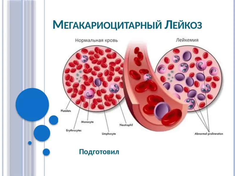 Острый мегакариоцитарный лейкоз 1