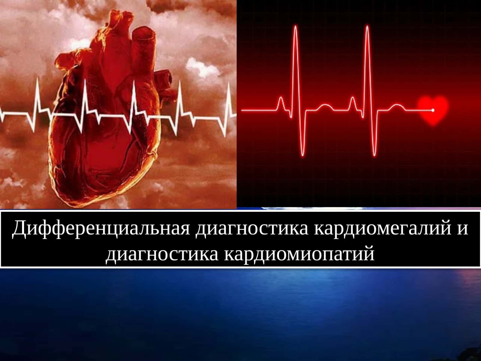 Дифференциальная диагностика кардиомегалий и диагностика кардиомиопатий 1