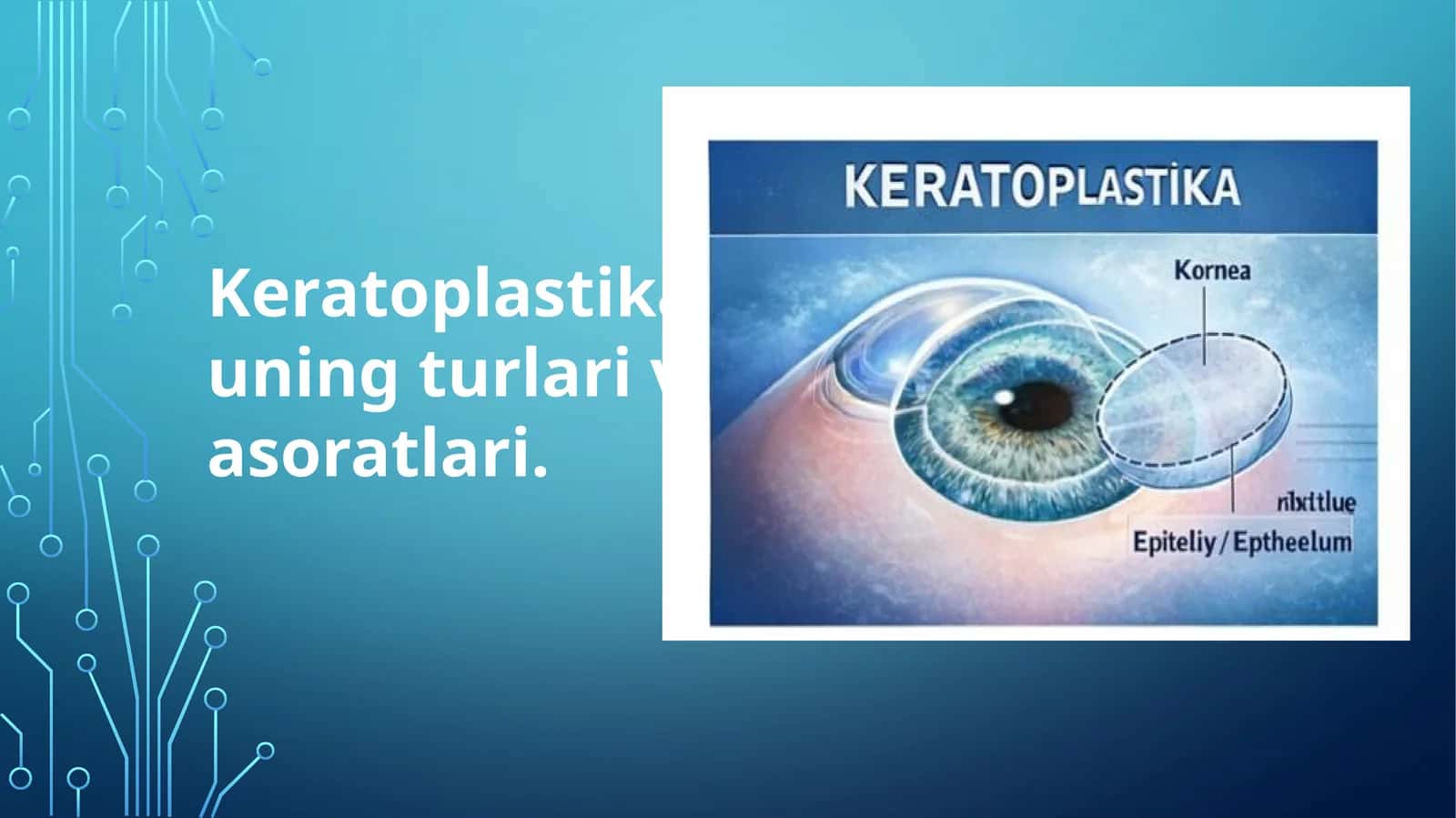 Keratoplastika, uning turlari va asoratlari 1