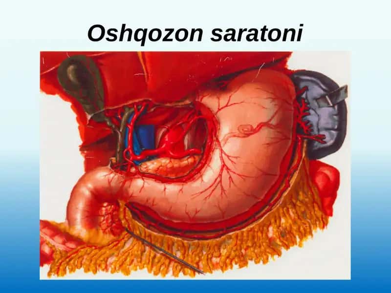 Oshqozonsaratoni 1