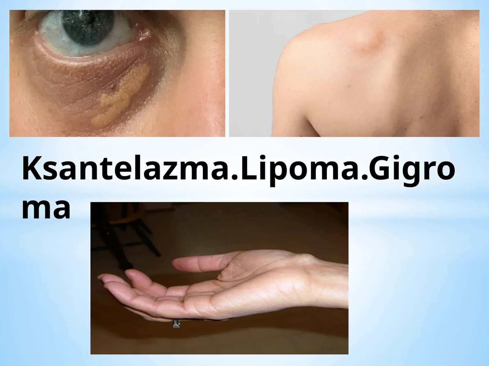Ksantelazma.Lipoma.Gigroma 1
