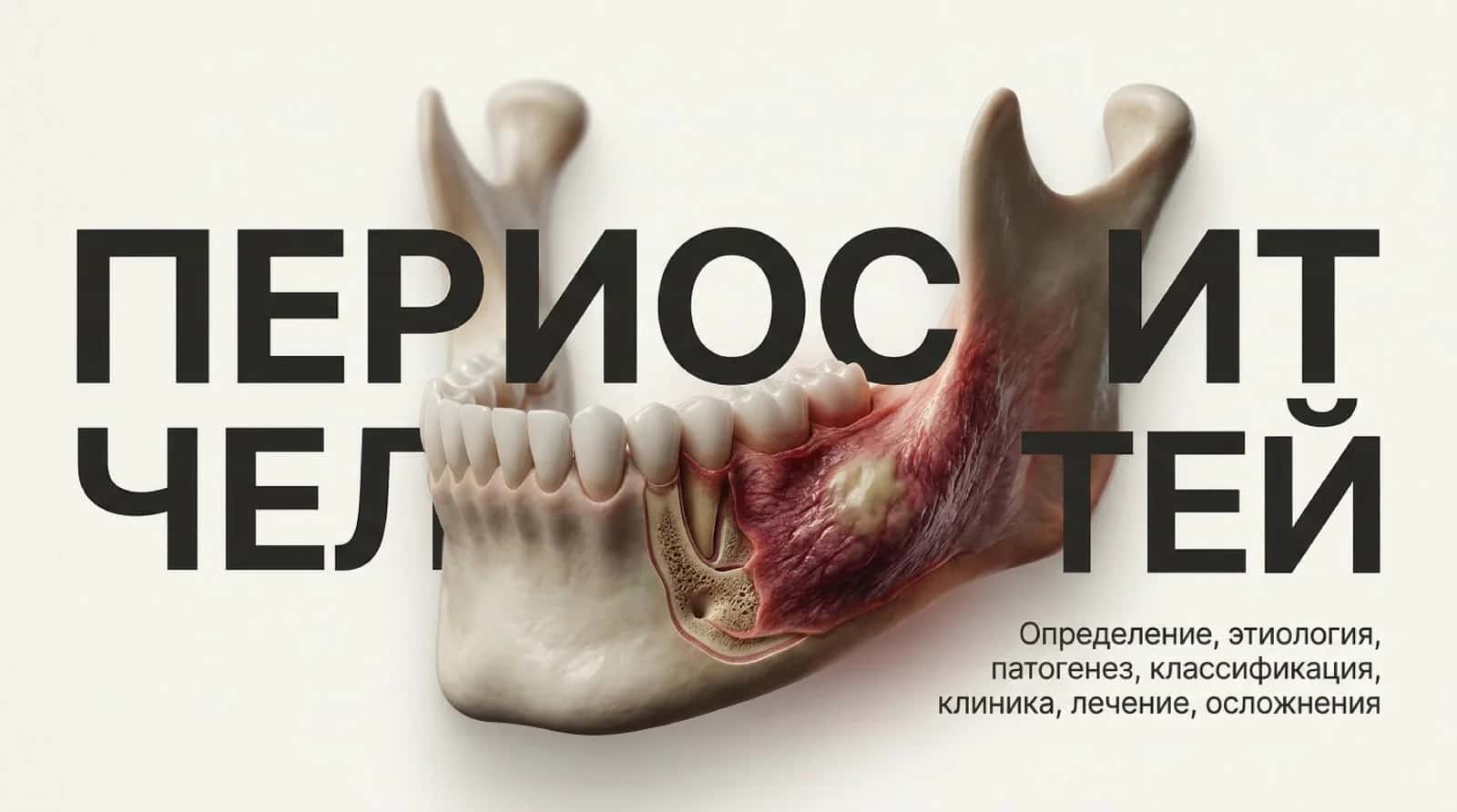Периостит челюстий 1