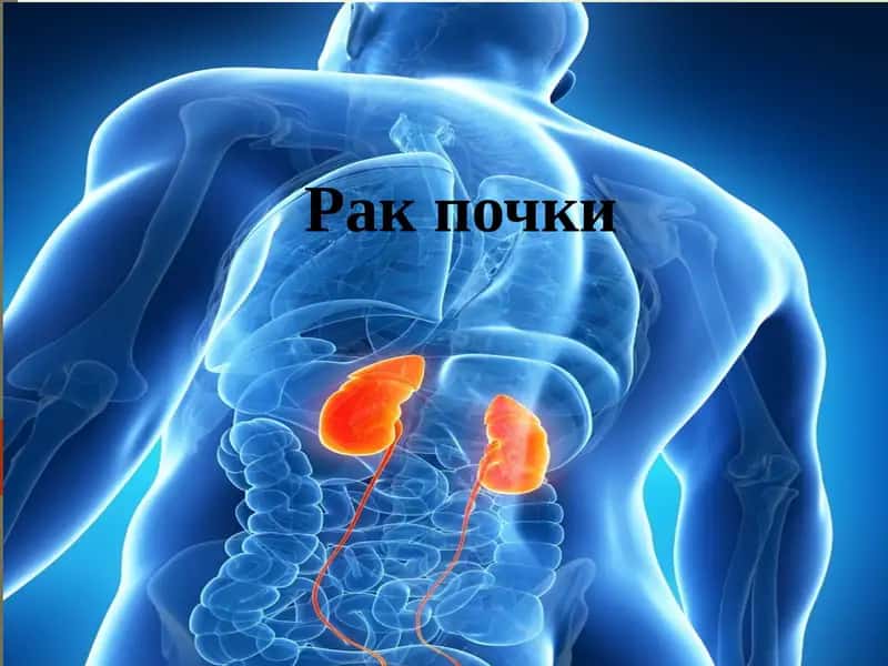 Рак почки 1