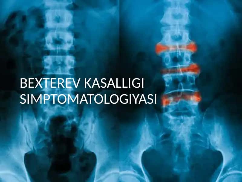 Bexterev kasalligi 1