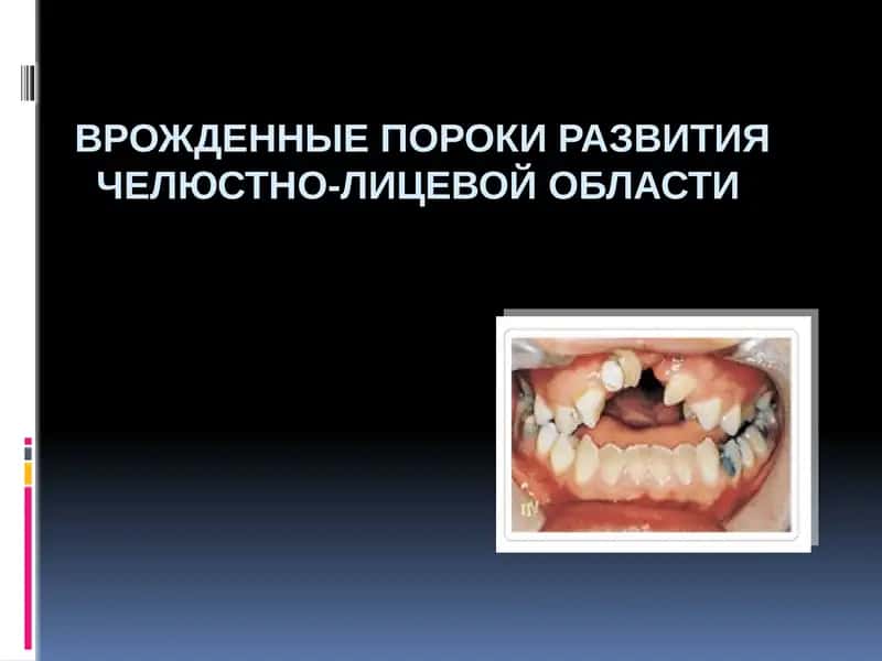Врожденные пороки развития челюстно-лицевой области 1