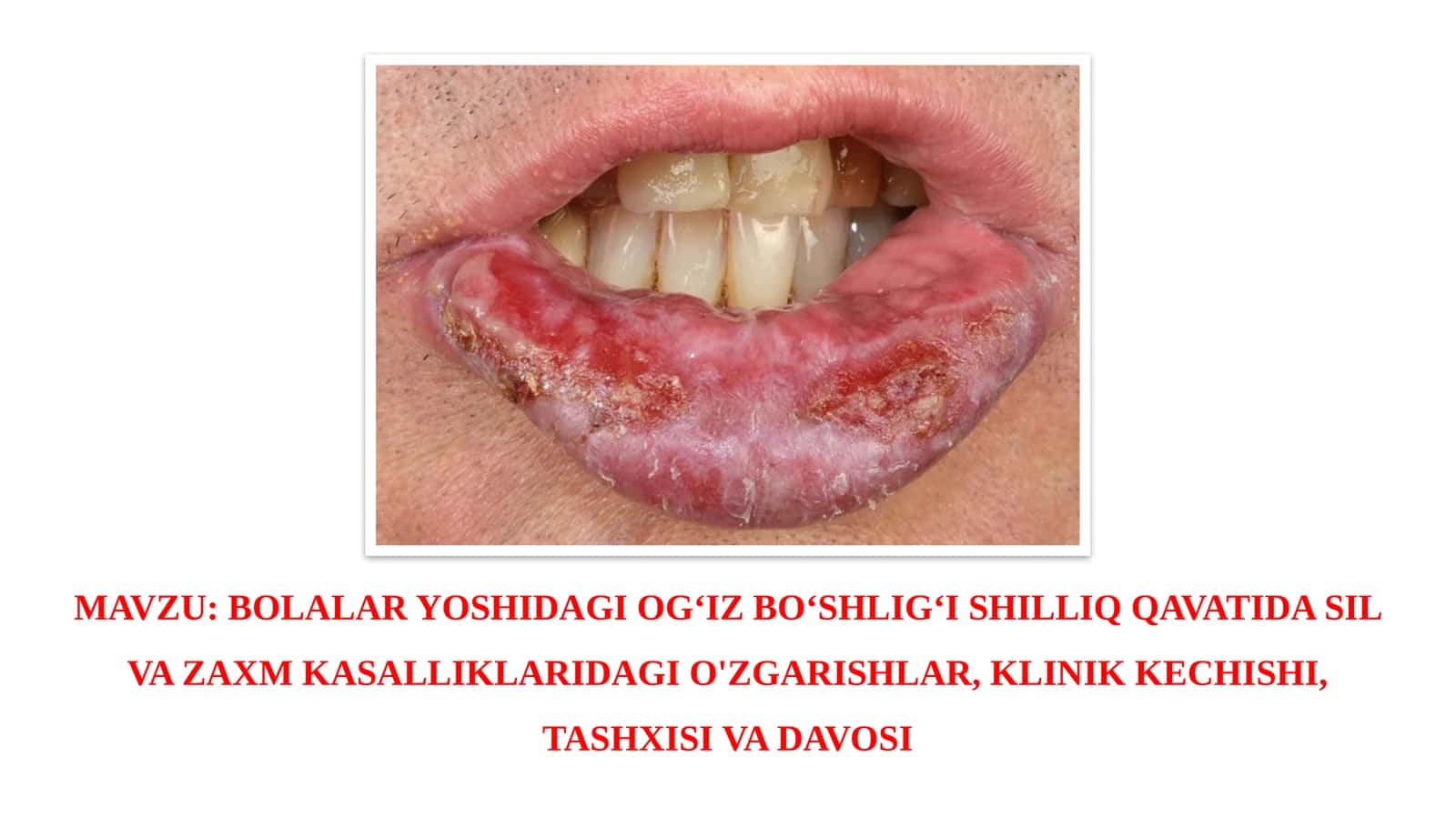 BOLALAR YOSHIDAGI OG‘IZ BO‘SHLIG‘I SHILLIQ QAVATIDA SIL VA ZAXM KASALLIKLARIDAGI O'ZGARISHLAR, KLINIK KECHISHI, TASHXISI VA DAVOSI 1