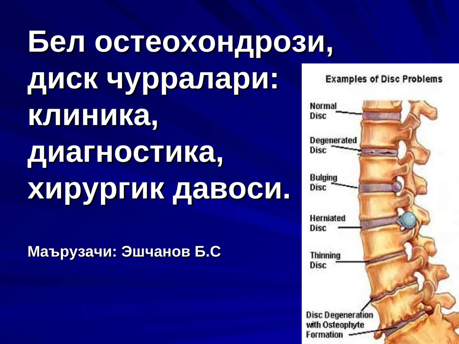 Бел остеохондрози 1