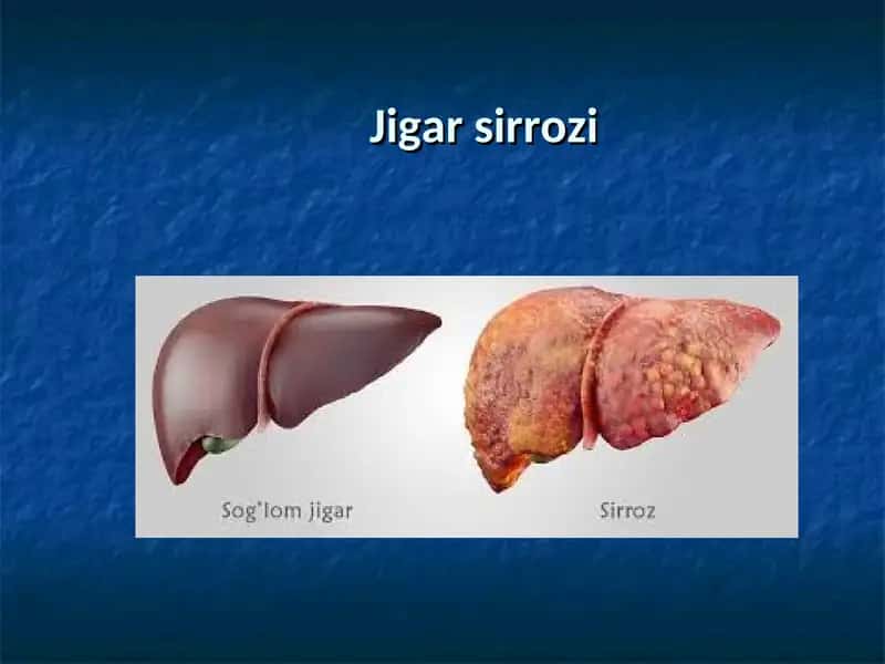 Jigar sirrozi 1