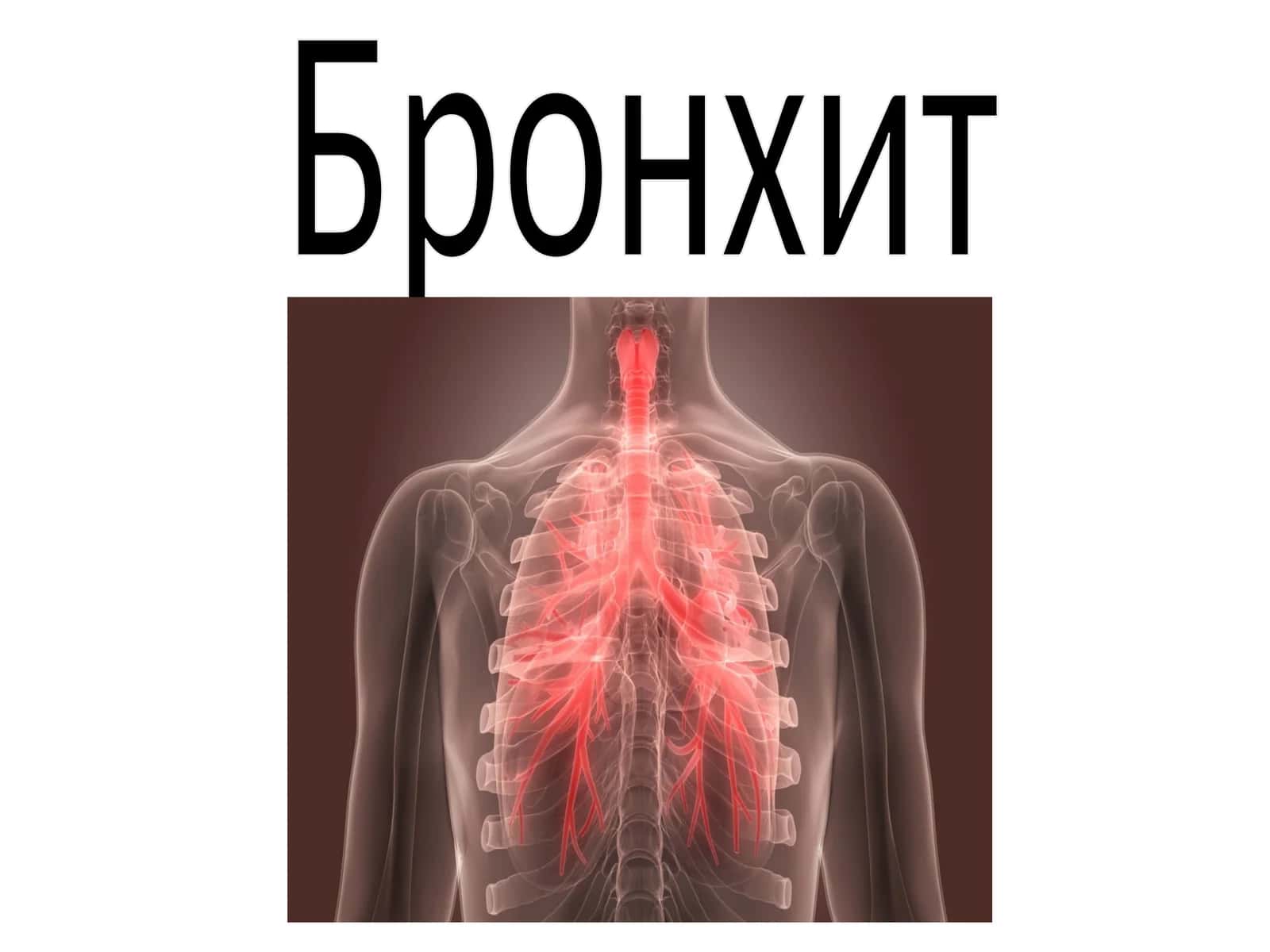 Острый бронхит 1