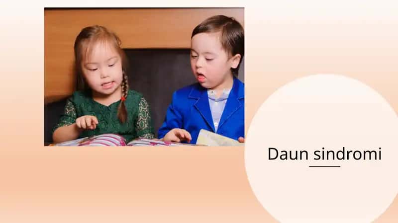 Daun sindromi 1