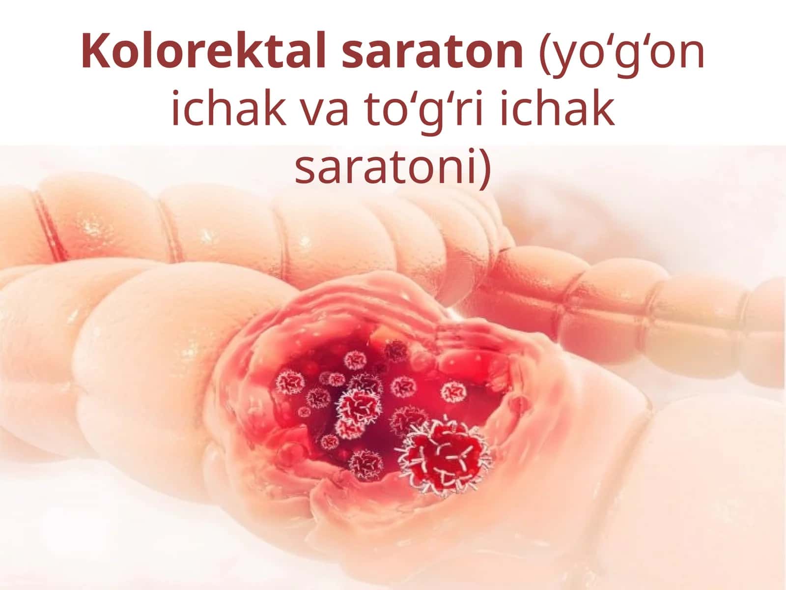 Kolorektal saraton(yo‘g‘on ichak va to‘g‘ri ichak saratoni) 1