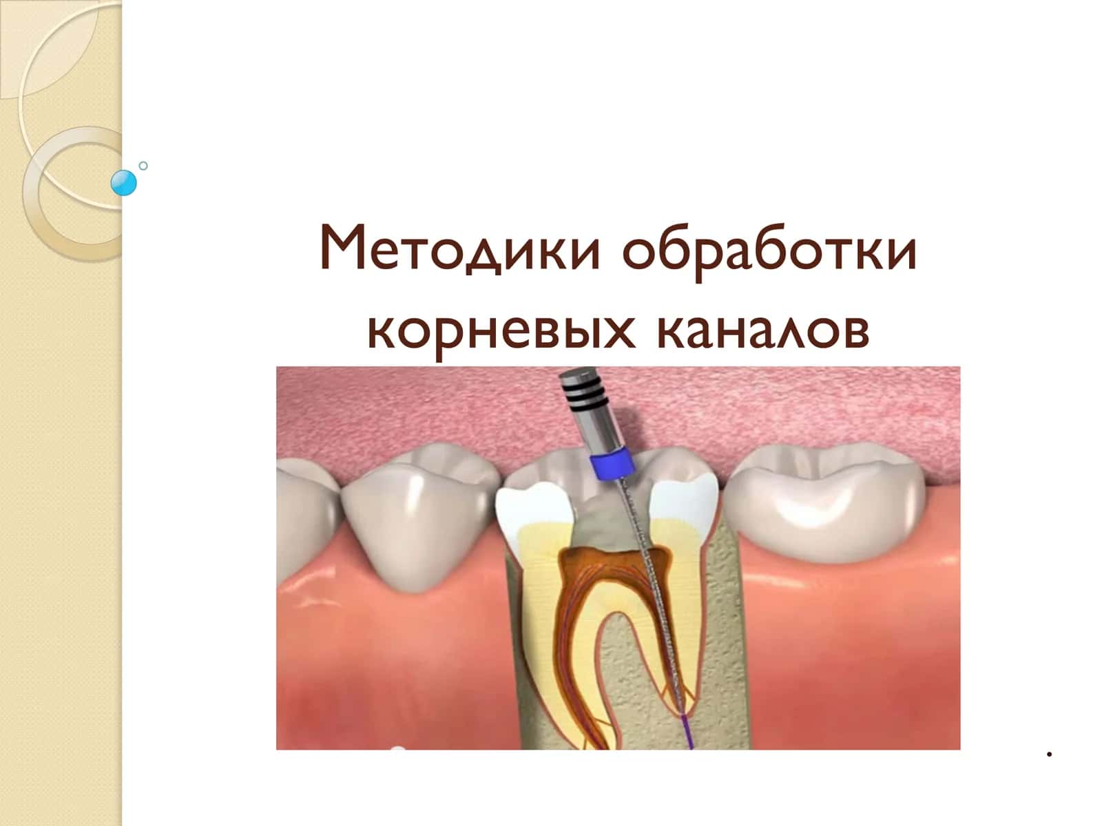 Методики обработки корневых каналов 1