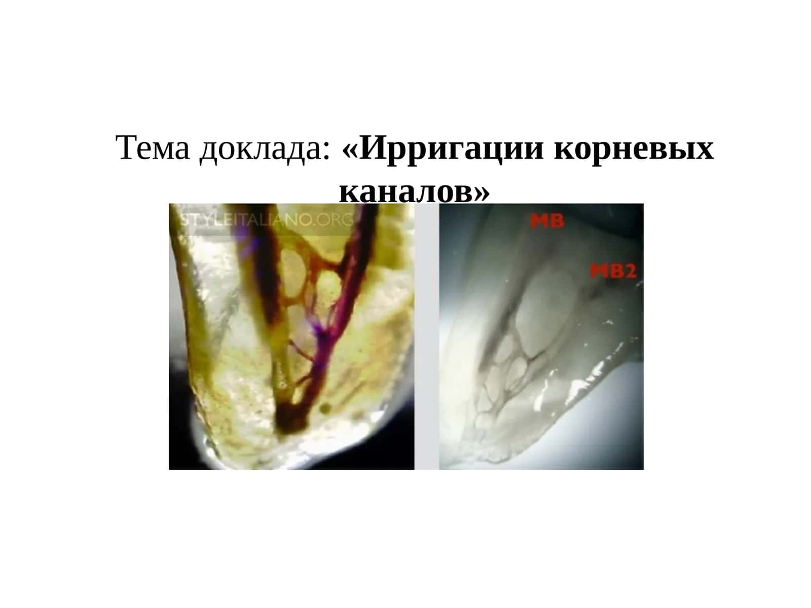 Ирригации корневых каналов 1