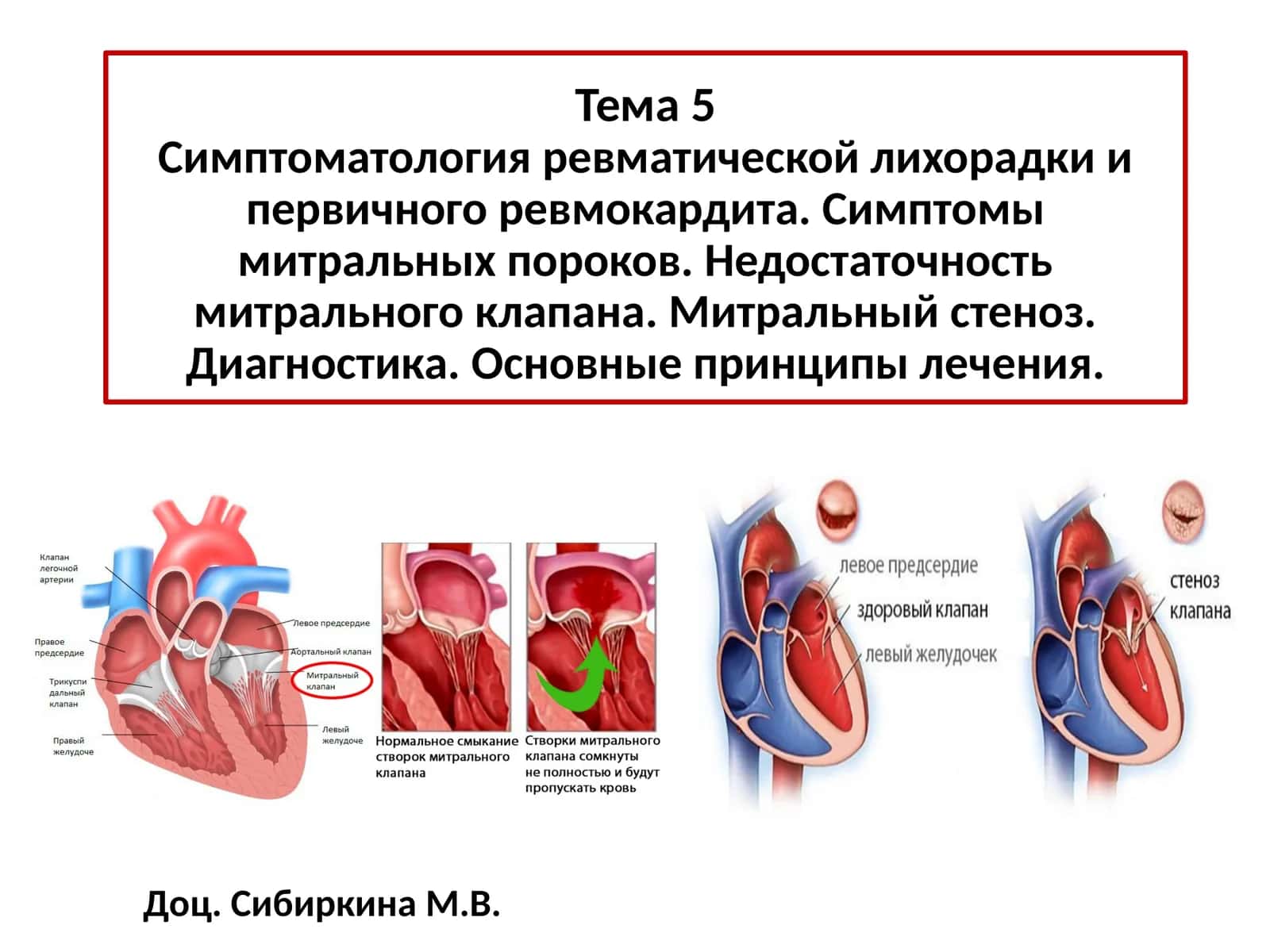 ОСТРАЯ РЕВМАТИЧЕСКАЯ ЛИХОРАДКА, ОПРЕДЕЛЕНИЕ 1
