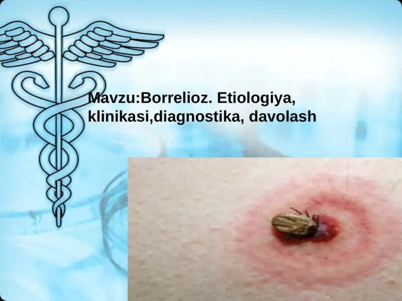 Borreliozlar 1