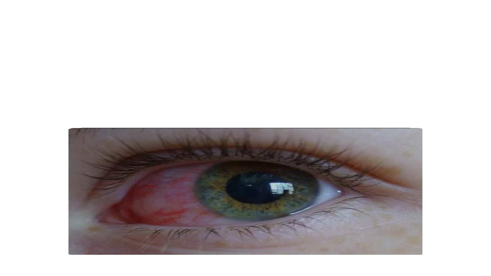 Gerpetikkonyunktivit 1