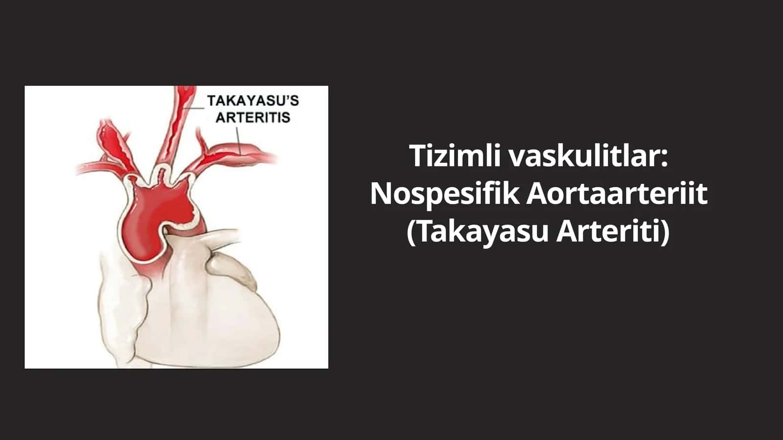 Takayasu Arteriti 1