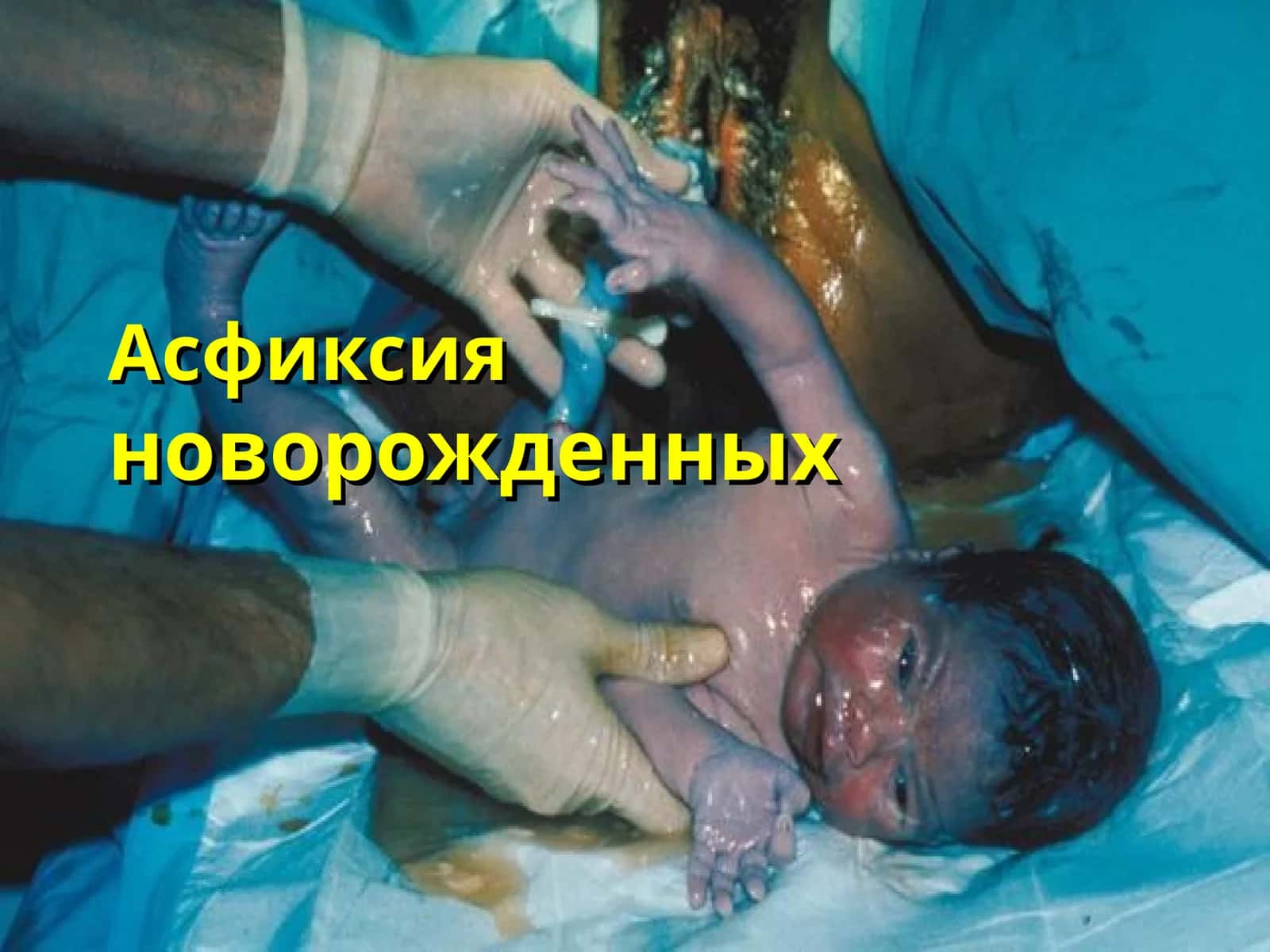 Асфиксияноворожденных 1
