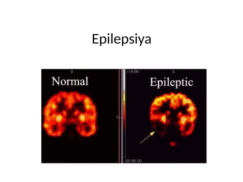 Epilepsiya 1