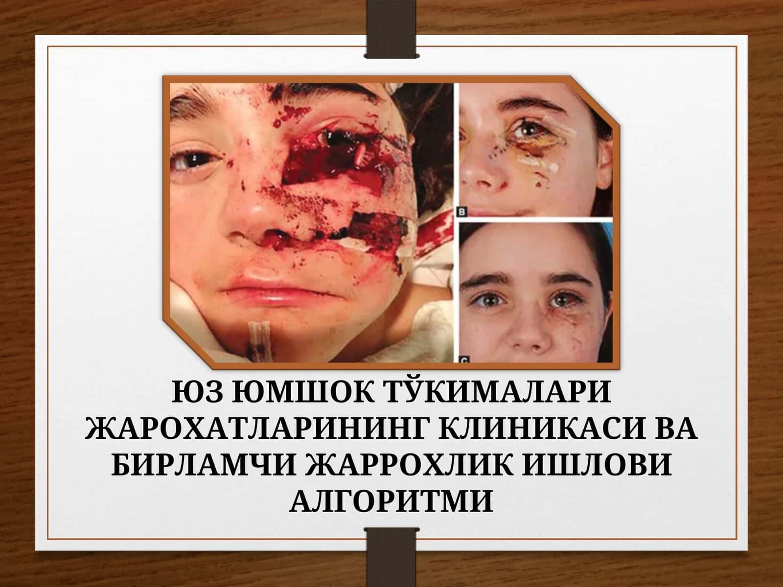 ЮМШОҚ ТЎҚИМАЛАРИ ЖАРОХАТЛАРИНИНГ КЛИНИКАСИ ВА БИРЛАМЧИ ЖАРРОХЛИК ИШЛОВИ АЛГОРИТМИ 1
