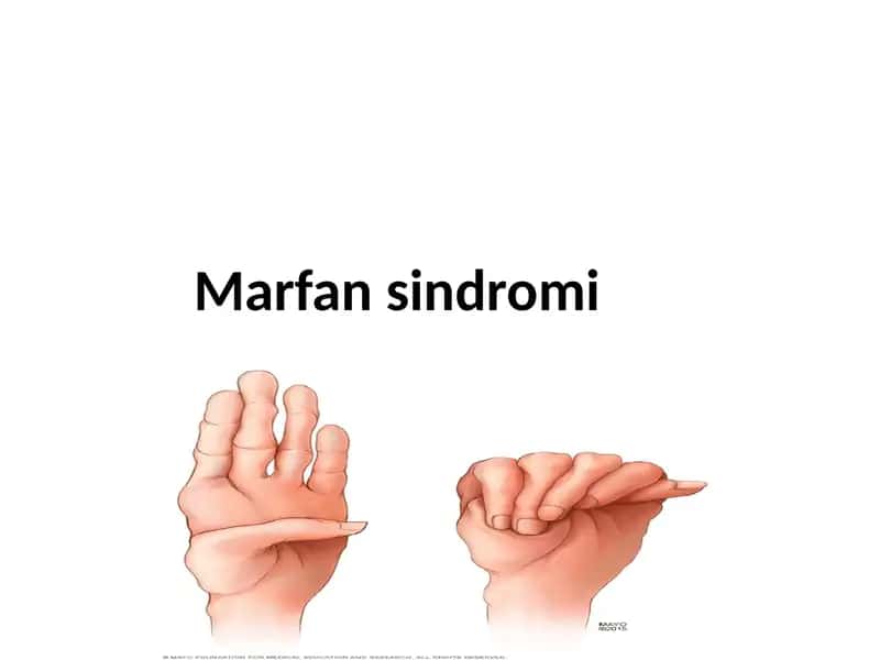 Marfan sindromi 1