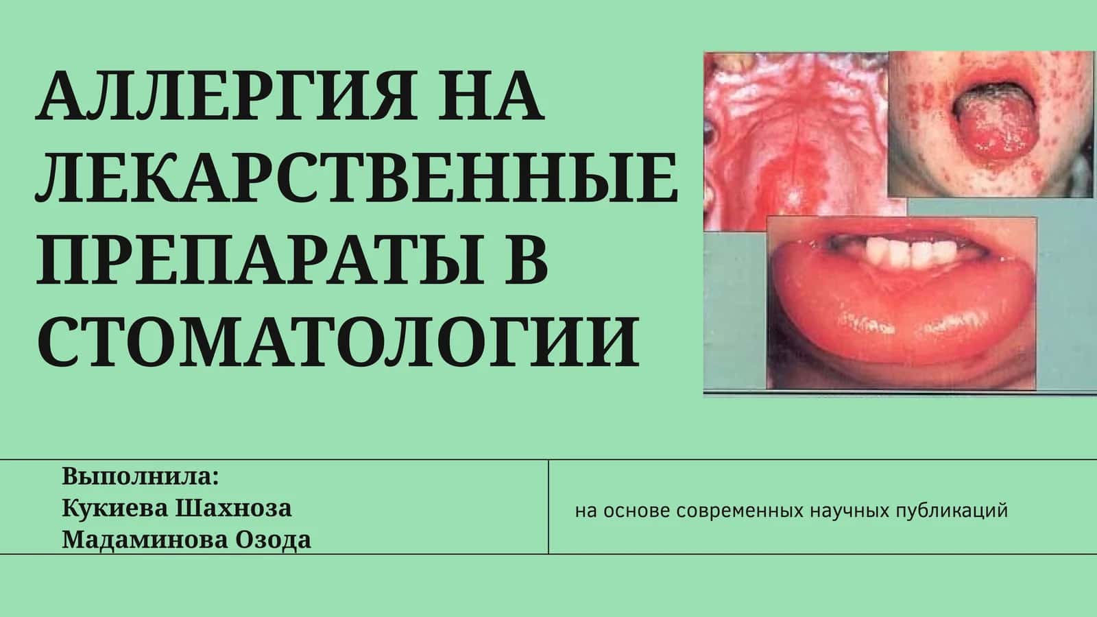 АЛЛЕРГИЯ НА ЛЕКАРСТВЕННЫЕ ПРЕПАРАТЫ В СТОМАТОЛОГИИ 1
