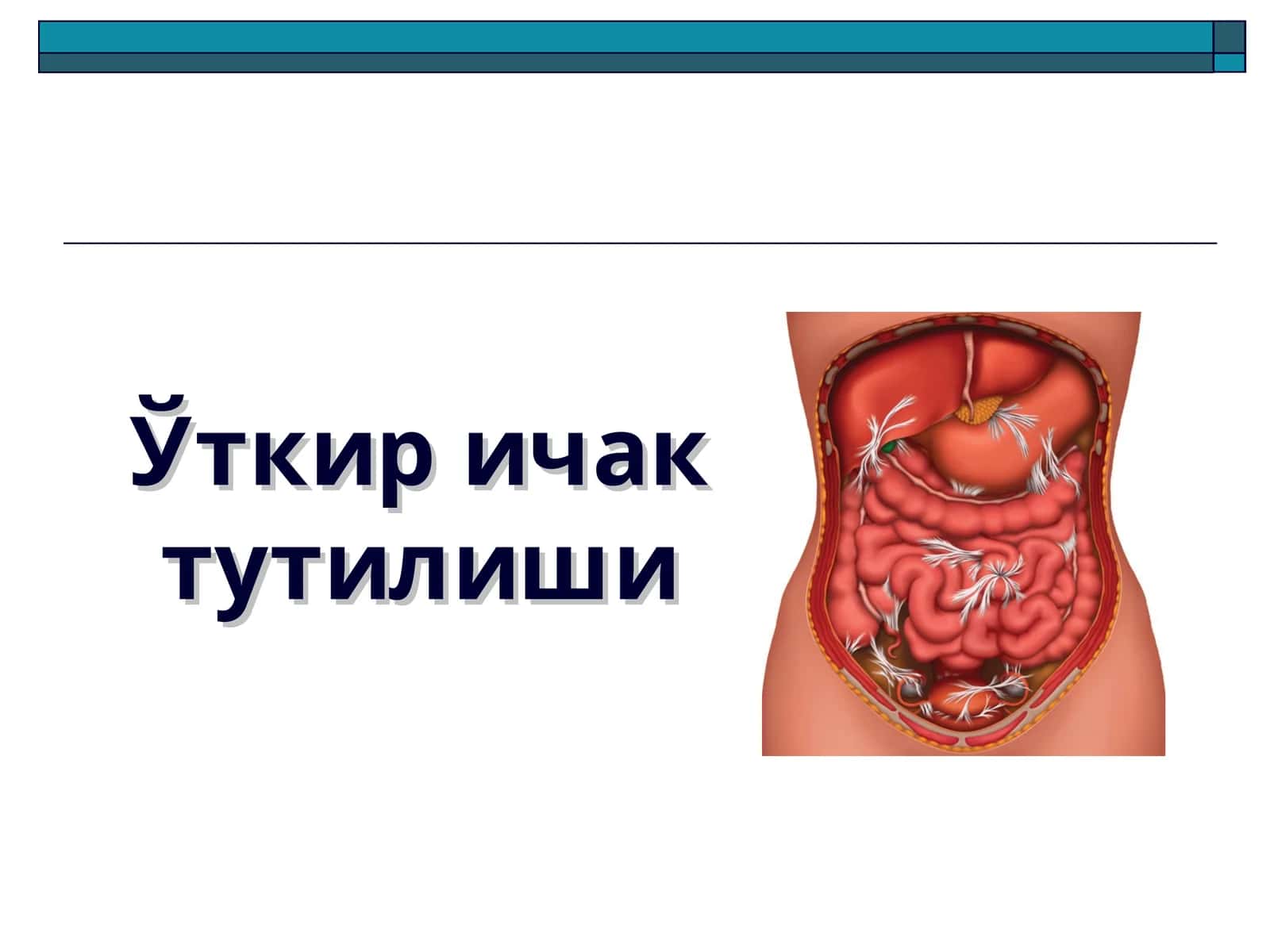 Ўткир ичак тутилиши 1
