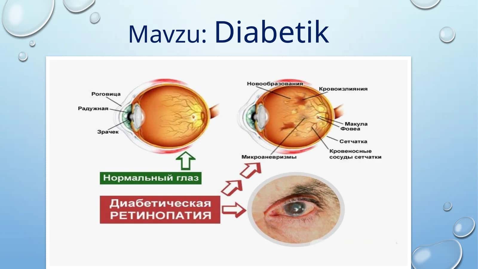 Diabetik retinopatiya 1