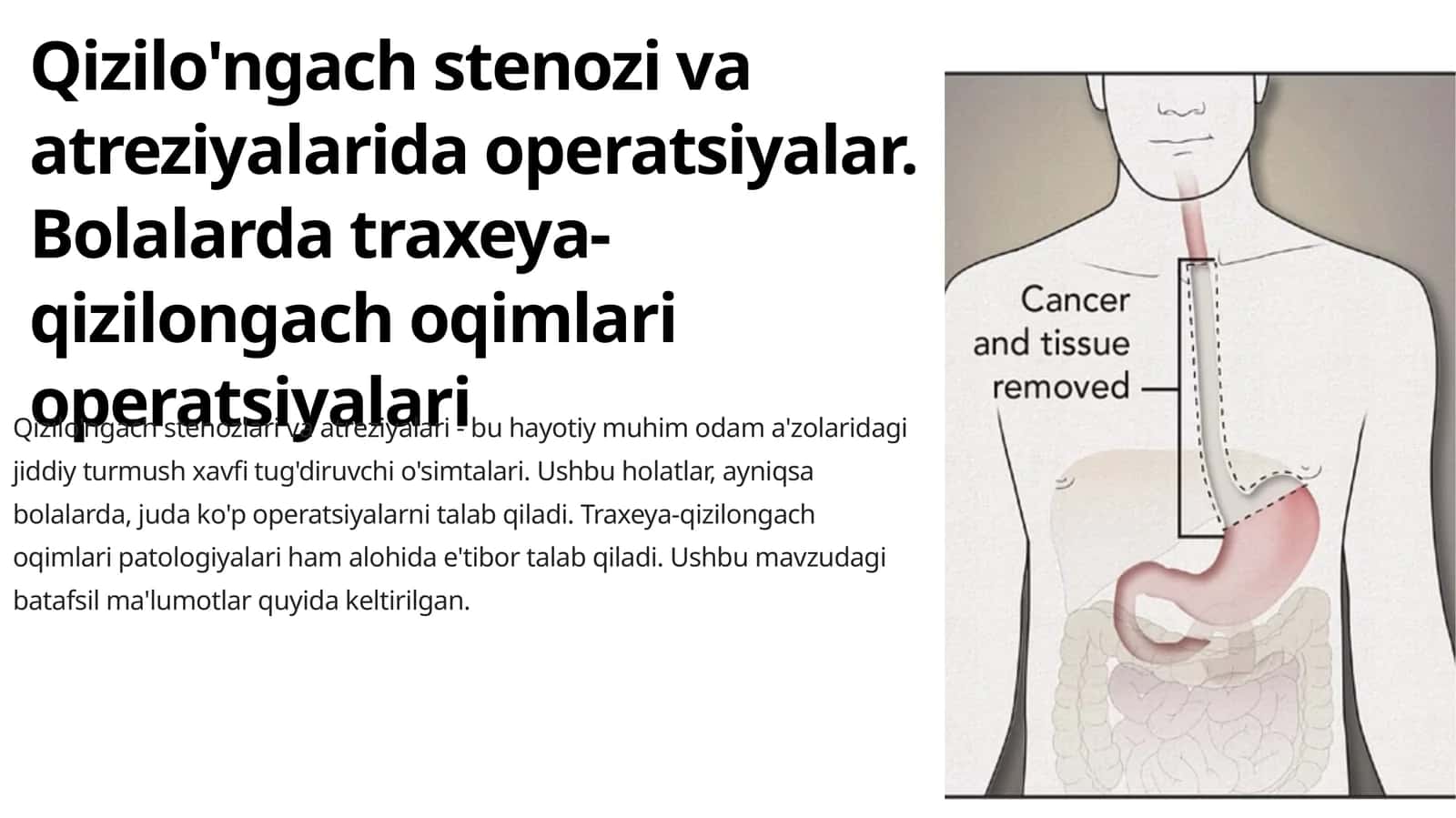 Qizilo'ngach stenozi va atreziyalarida operatsiyalar. Bolalarda traxeya-qizilongach oqimlari operatsiyalari 1