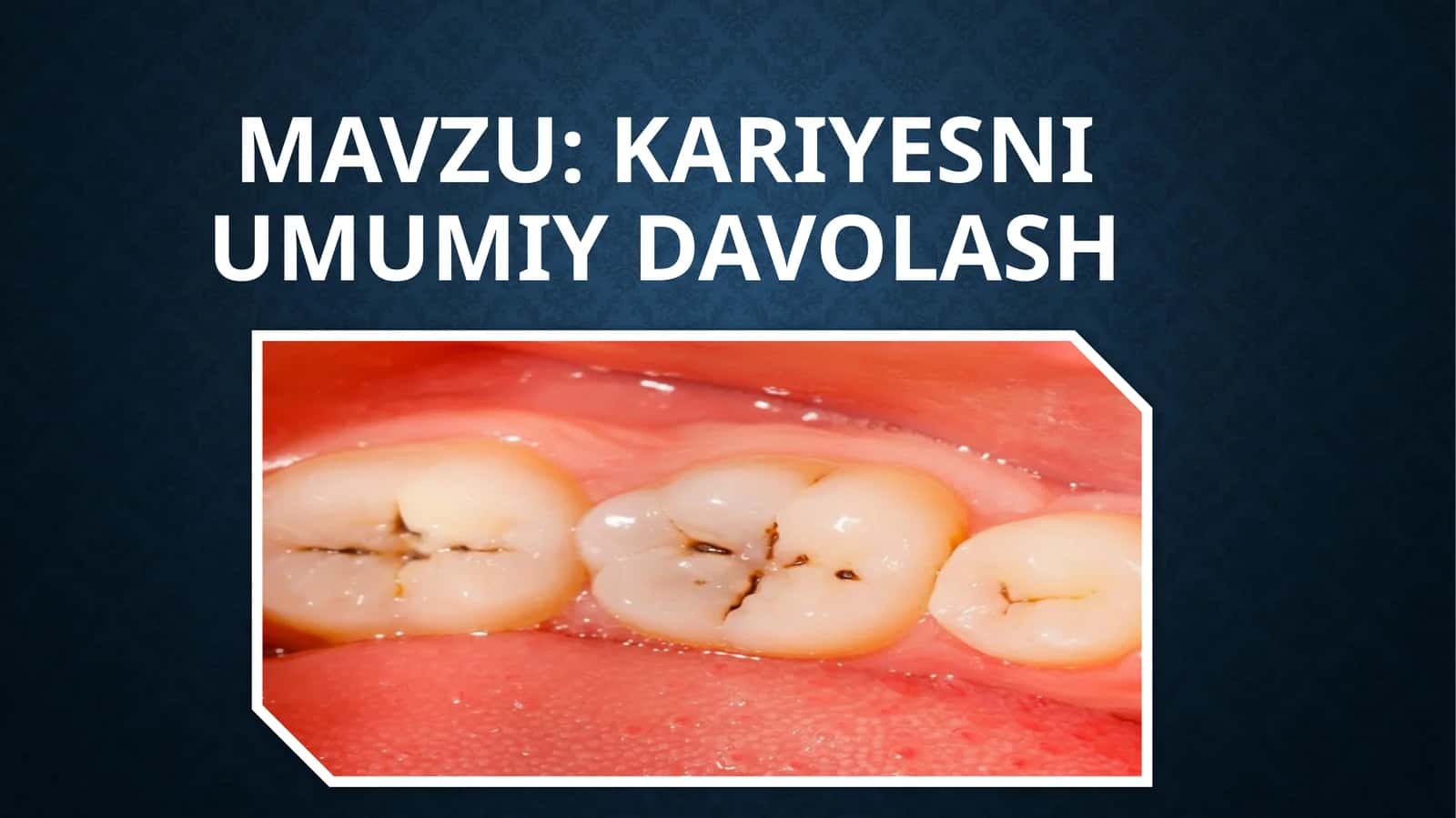 Kariesni umumiy davolash 1