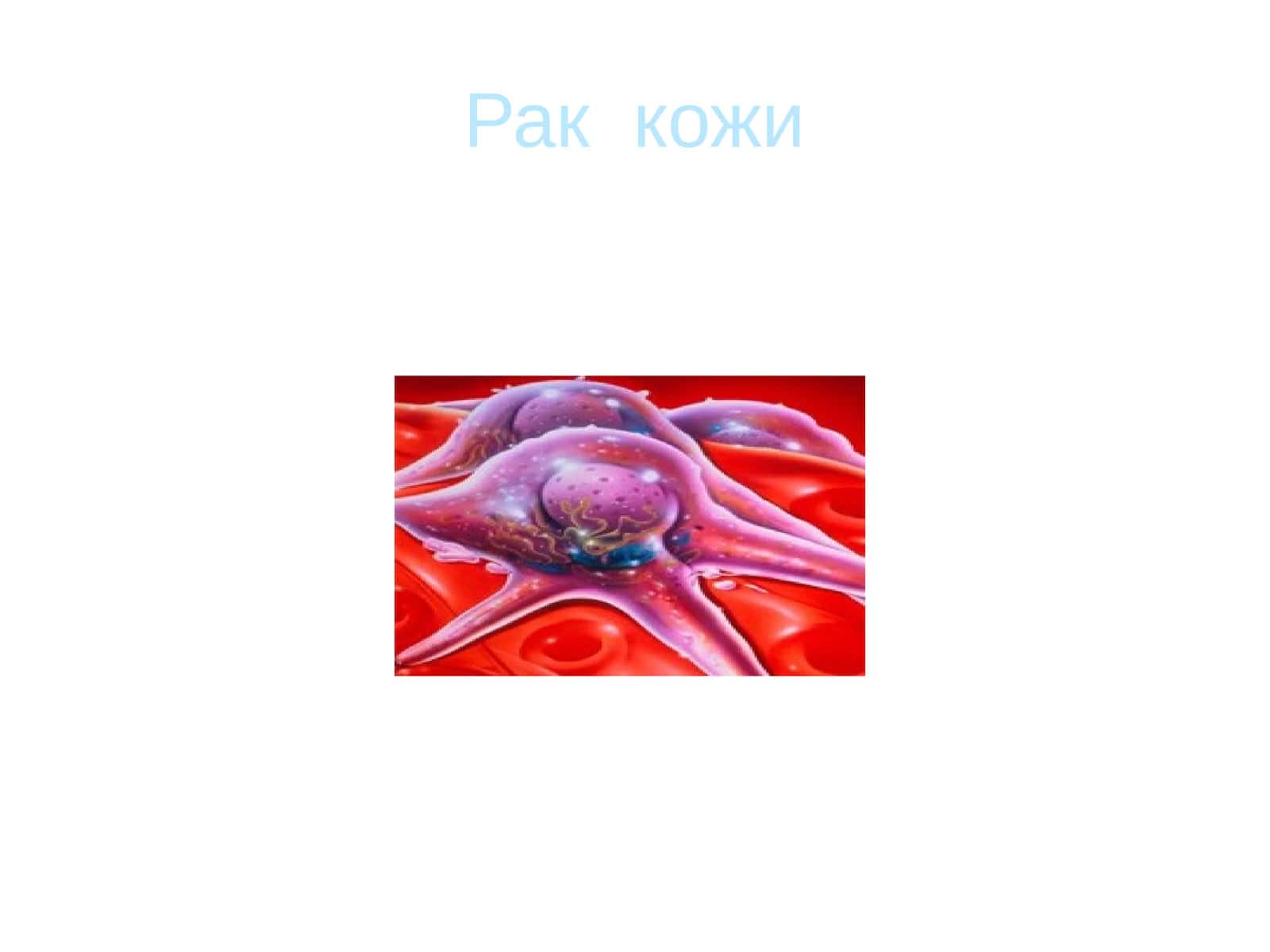 Рак кожи 1