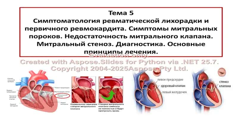 Симптоматология ревматической лихорадки и первичного ревмокардита 1