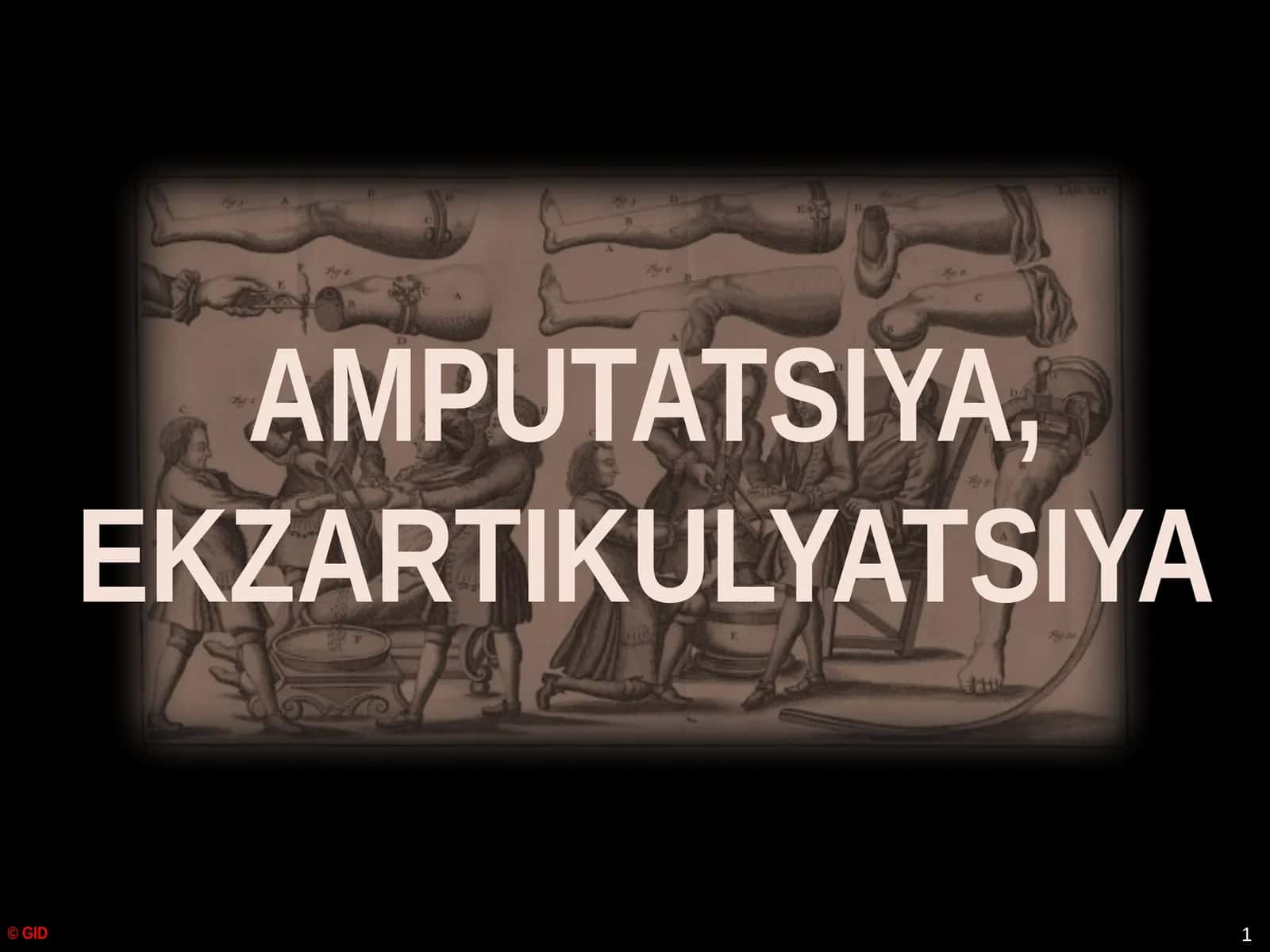 Amputatsiya, Ekzartikulyatsiya 1