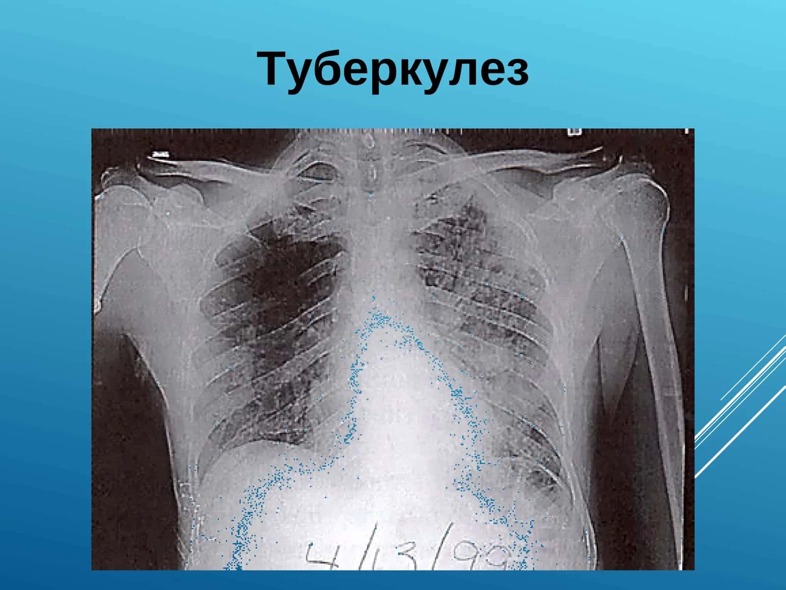 Tuberkulyoz. Tubrkulyoz 1