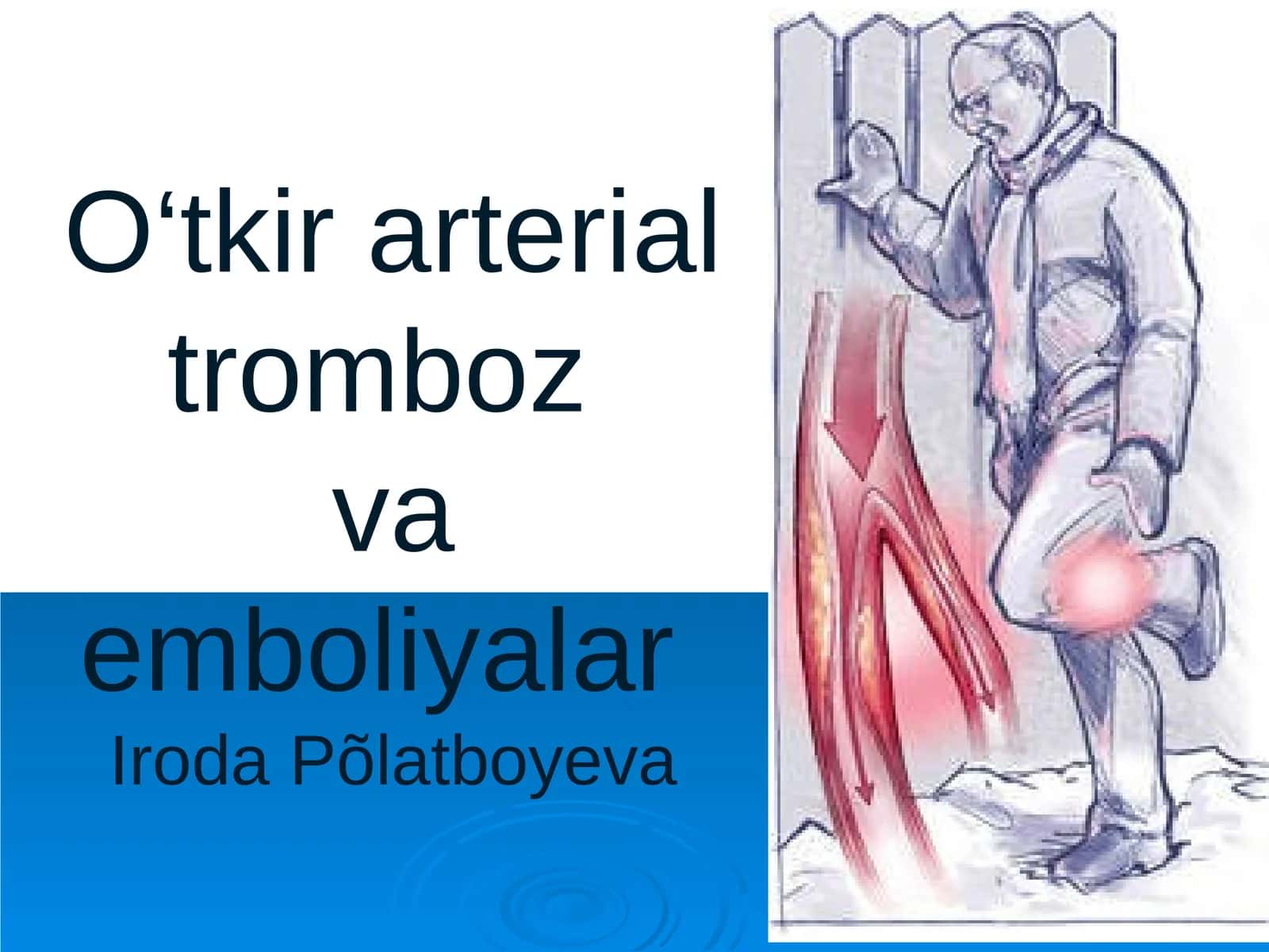 O‘tkir arterial trombozva emboliyalarIrodaPõlatboyeva 1
