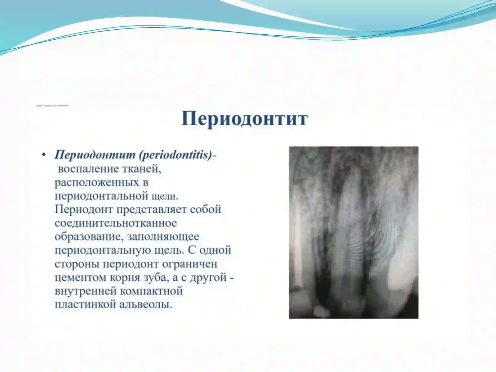 Острый апикальный периодонтит - клиника,диагностика 2