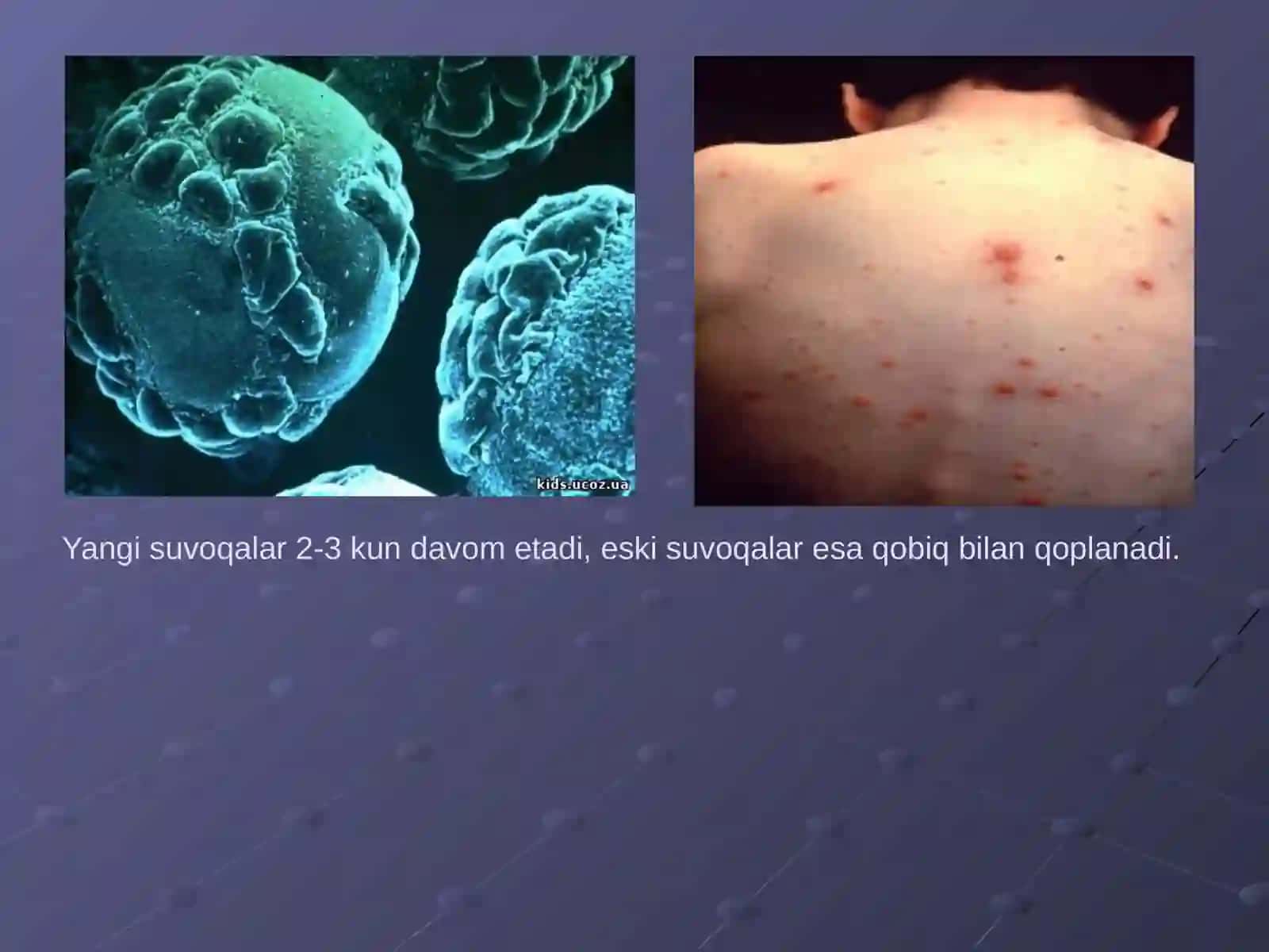 Suvchechak kasalligi va klinik belgilari 2