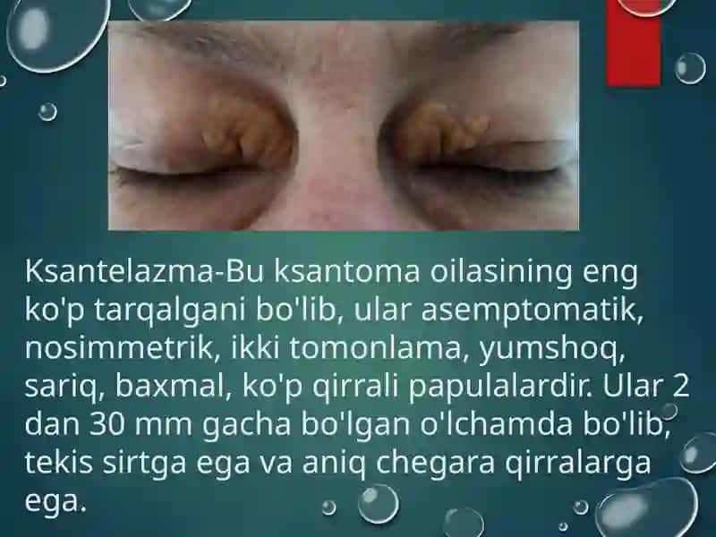 Ksantelazma.Lipoma.Gigroma 2