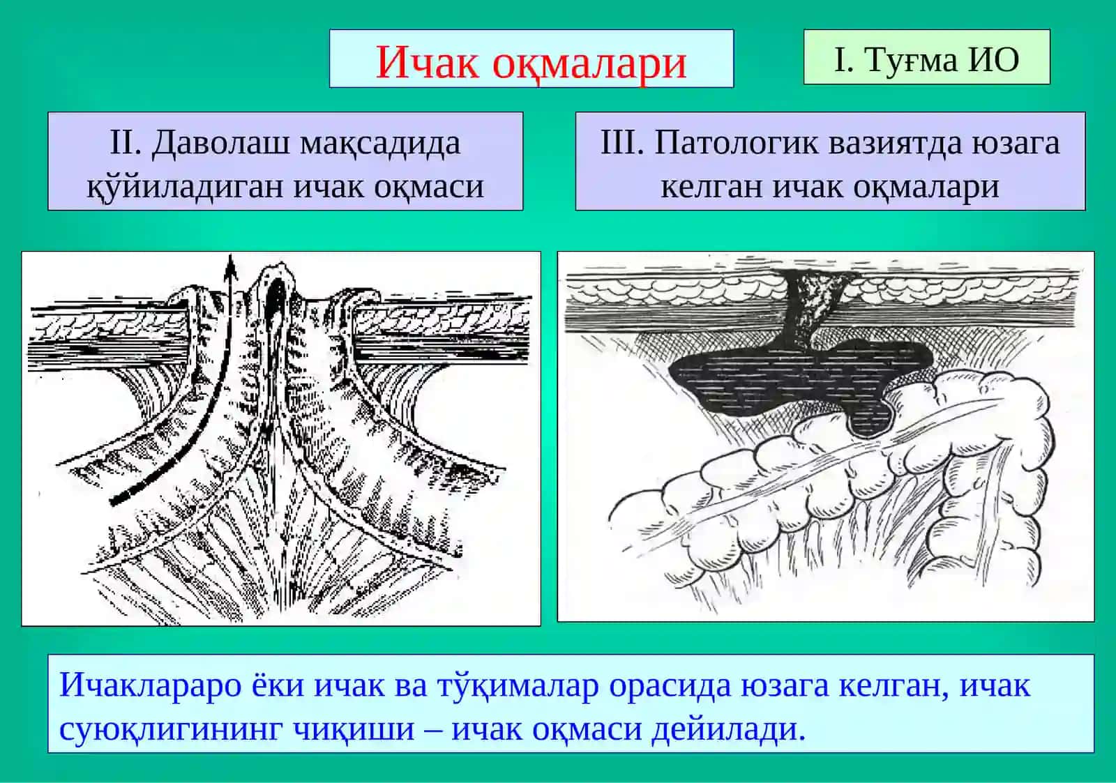 Ичак оқмалари 2