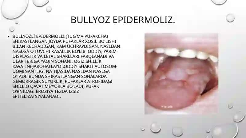 Bullyozepidermoliz 2
