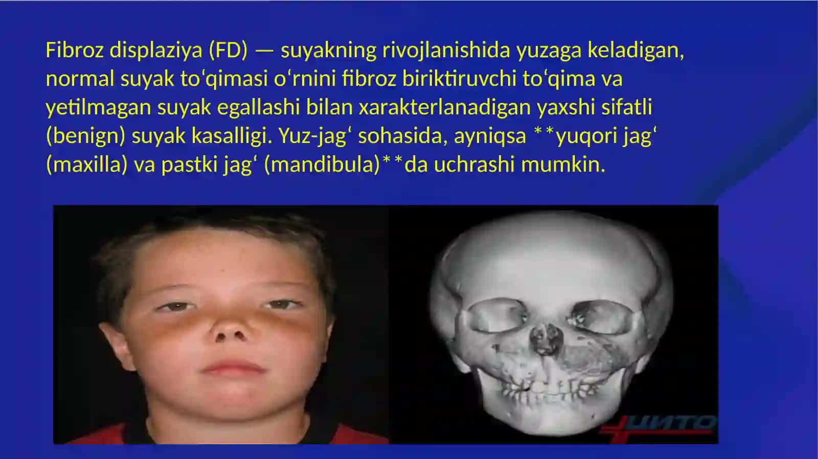 Fibroz displaziya klinikasi 2