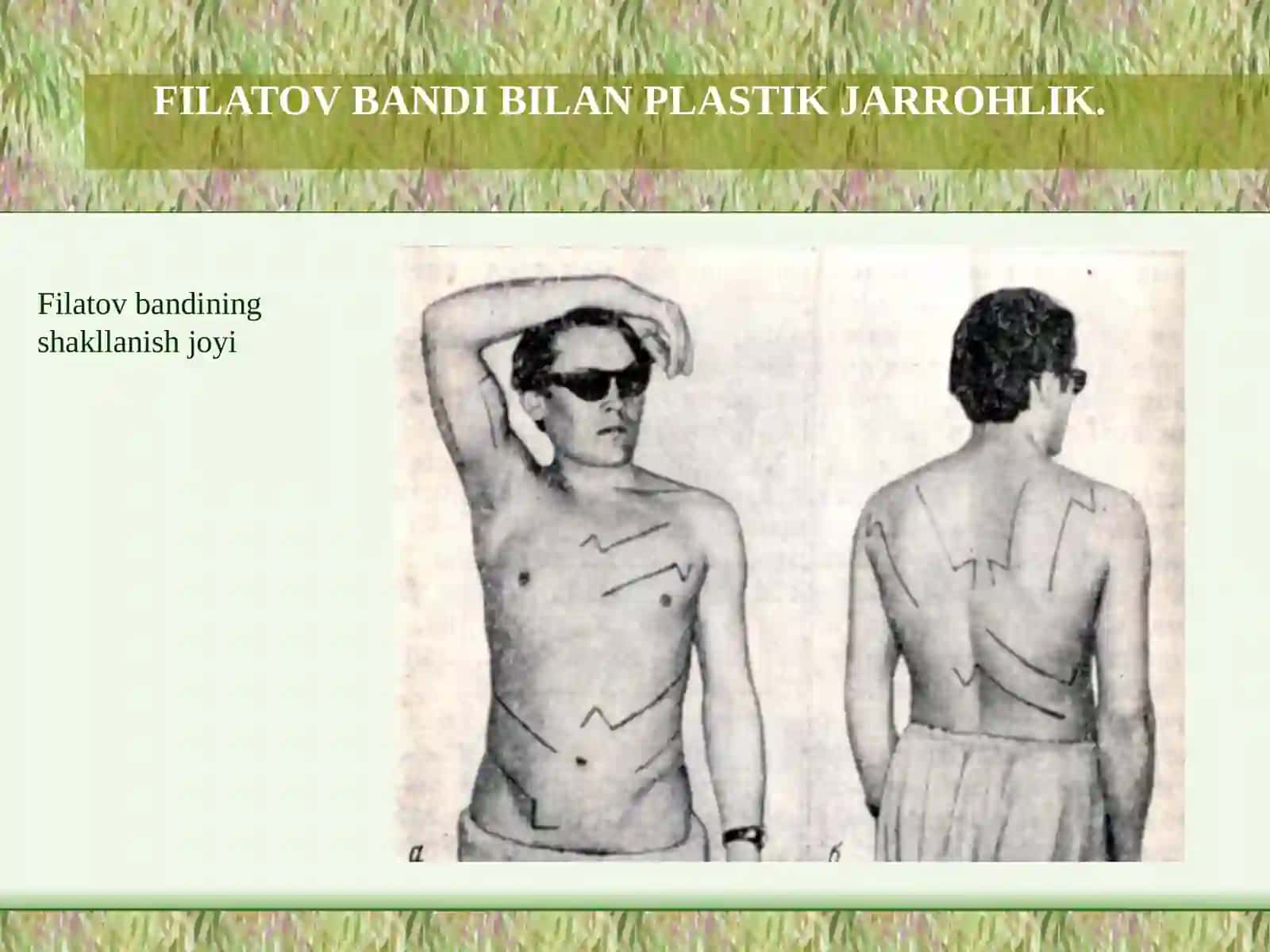 FILATOV BANDIBILAN PLASTIK JARROHLIK 2
