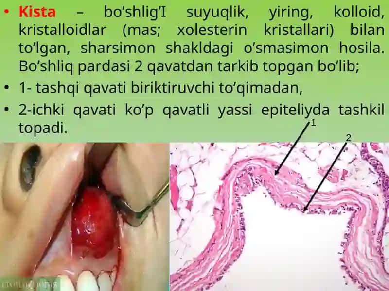 Anevrizmal suyak kistasi (ASK) 2