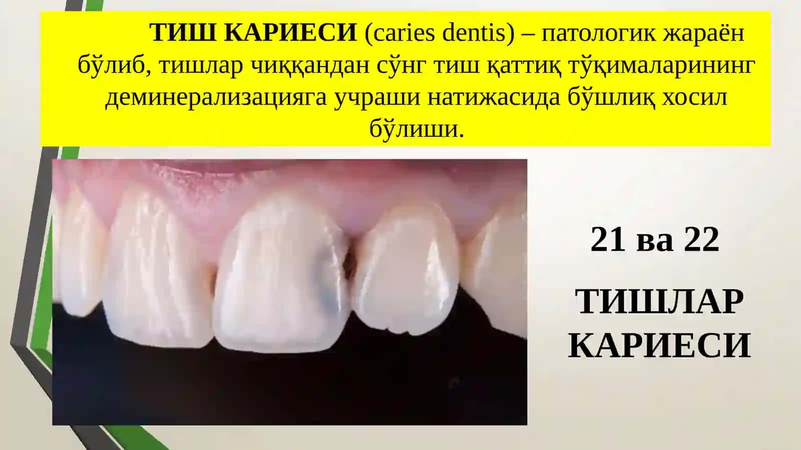Karies haqida umumiy maʼlumot. Kareis kovaklar tasnifi. Blek klassifikatsiyasi boʻyicha karies kovaklar tasnifi (slayd/ prezintatsiya/ mustaqil ish/ taqdimot) 2