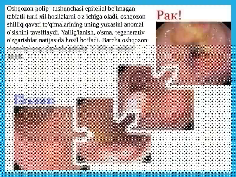 Oshqozon polipozi 2