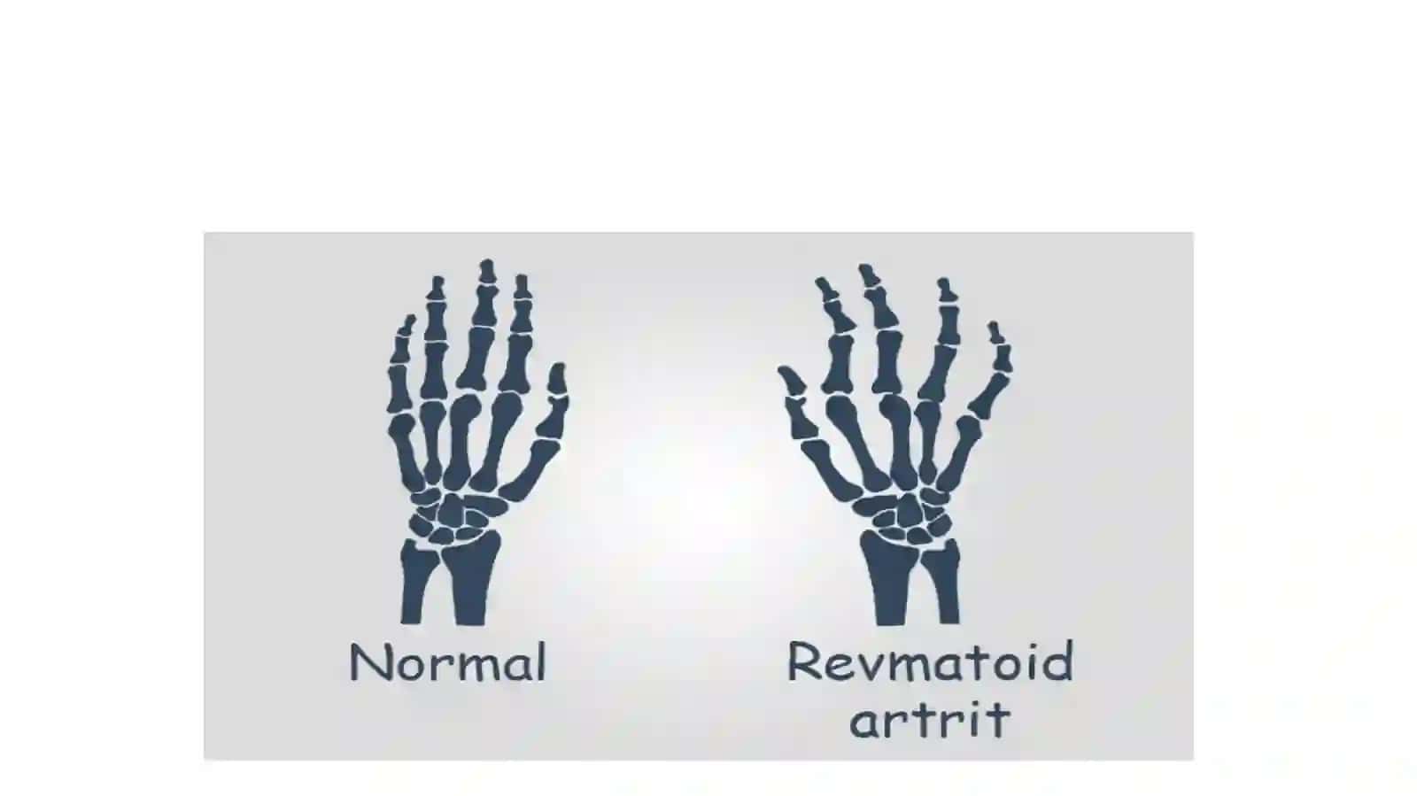 REVMATOID ARTRIT — ETIOLOGIYASI, KLINIKASI, TASNIFI, TASHXISLASH VA DAVOLASH USULLARI 2